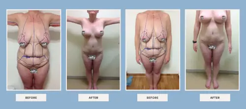 body-procedures-before-after-2