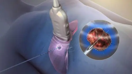 EPS RFA Treatment Cost in India