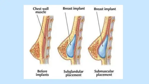 boob job implant position