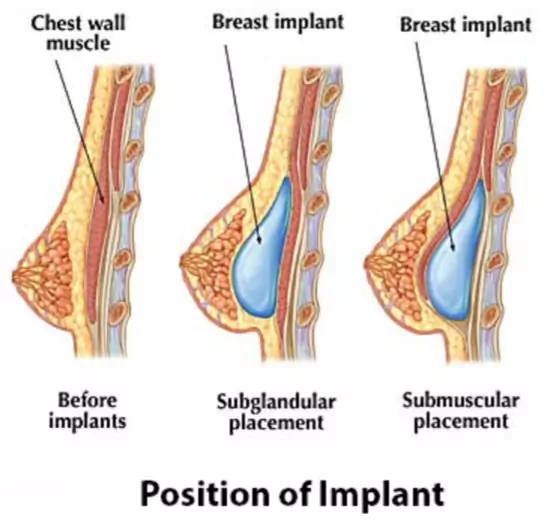 boob job implant position