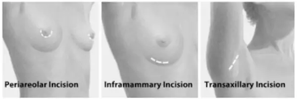 boob job incision