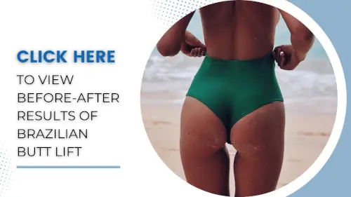 view-before-after-results-of-brazilian-butt-lift-surgery