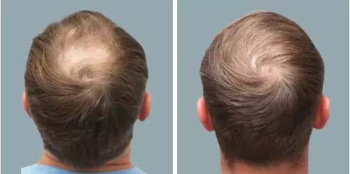 Before and After