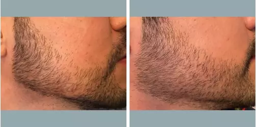 Before and After