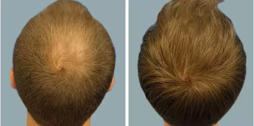 Before and After