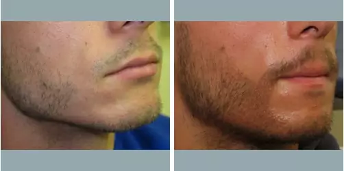 Before and After