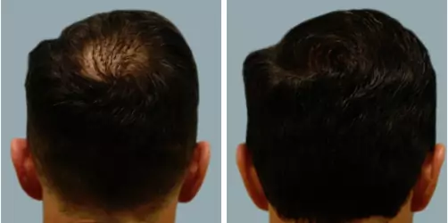 Before and After