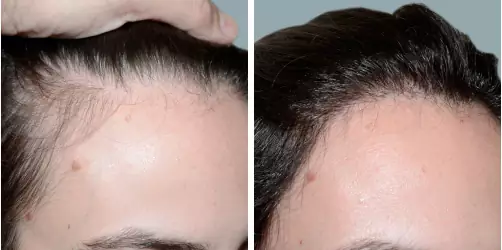 Before and After
