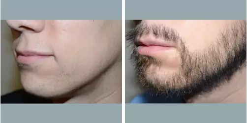 Before and After
