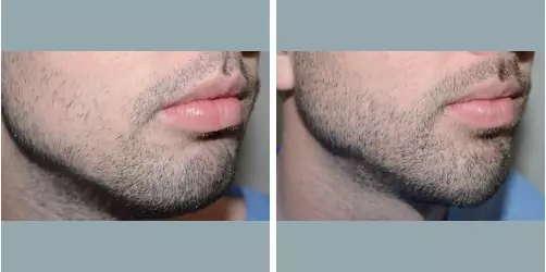 Before and After