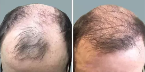 Before and After