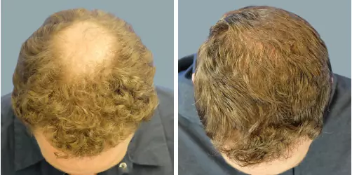 Before and After