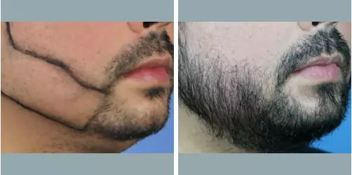 Before and After