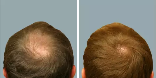 Before and After