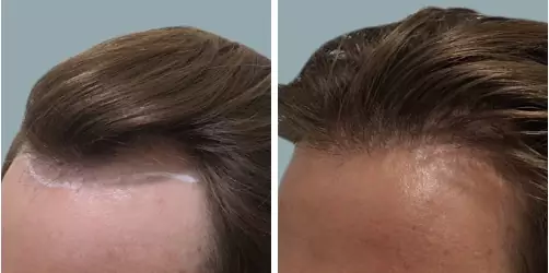 Before and After