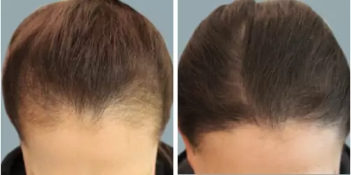 Before and After