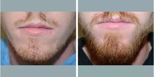 Before and After