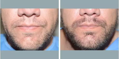 Before and After