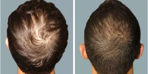 Before and After