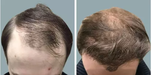 Before and After