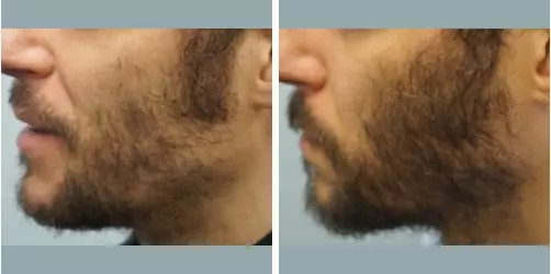 Before and After