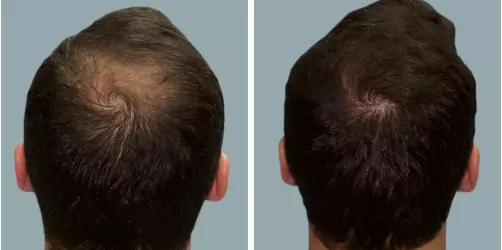 Before and After