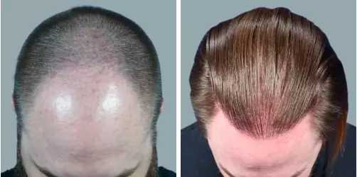 Before and After