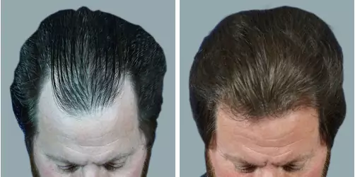Before and After