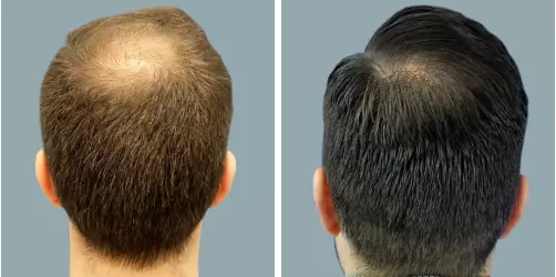 Before and After