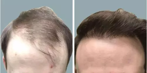 Before and After