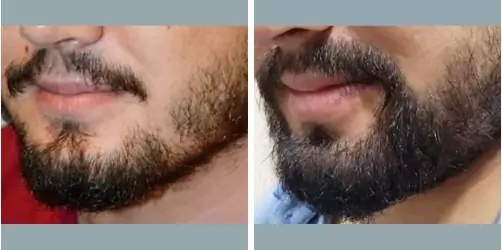 Before and After