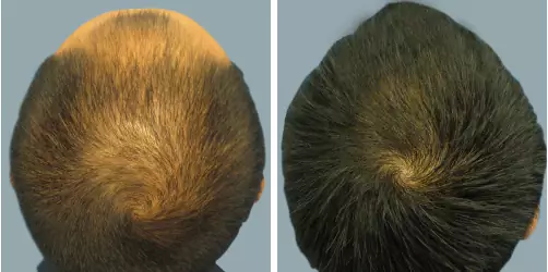 Before and After