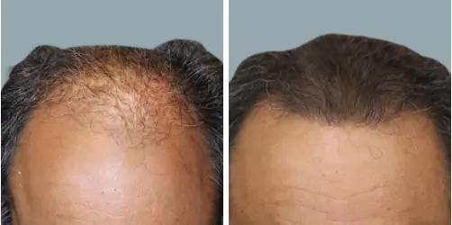 Before and After
