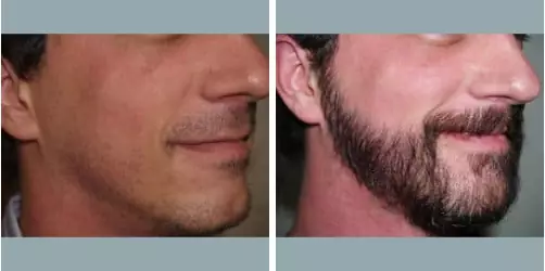 Before and After
