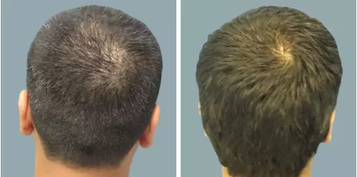 Before and After