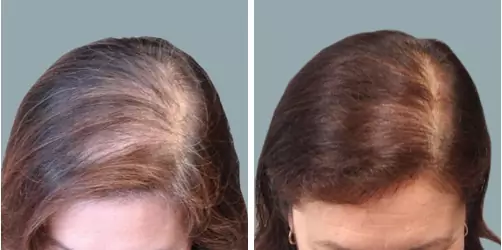 Before and After