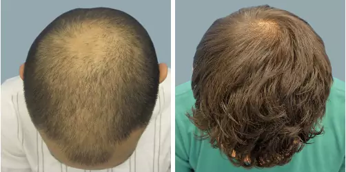Before and After