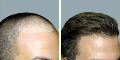 Before and After