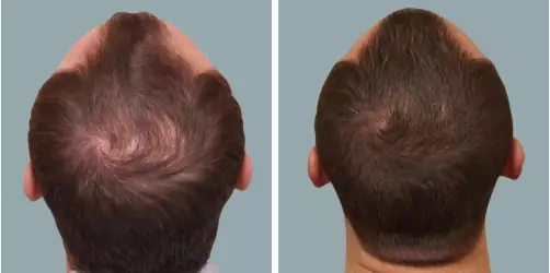 Before and After