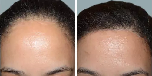 Before and After