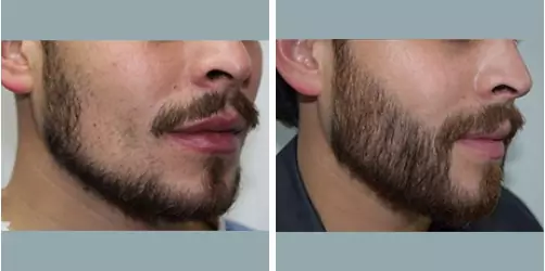 Before and After