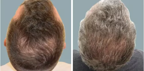Before and After