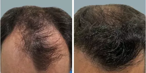Before and After
