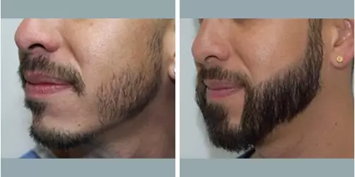 Before and After