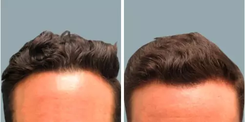Before and After