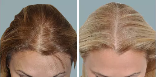 Before and After