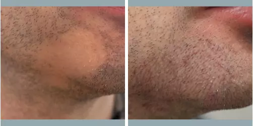 Before and After