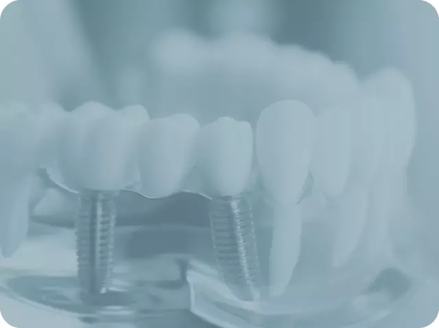 Dental Implants