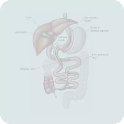 Duodenal Switch