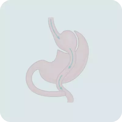 Gastric Bypass